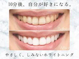 【お急ぎの方はこちら】最速プレミアムセルフホワイトニング (2来店60分照射)