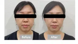 【小顔/むくみ/左右差】フェイスライン集中ケア60分 ¥2,980