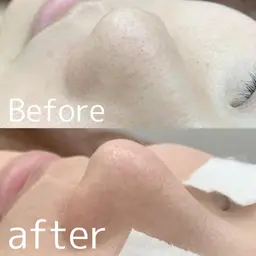 【毛穴洗浄/ざらつき】毛穴すっきり洗浄＋保湿ケア ¥4,980