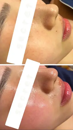 整形級!?💎エステ式ダーマペン💎最新美容✨【医療💉×エステ💆】エクソソーム✨小顔💖リフトアップ、毛穴にも💗