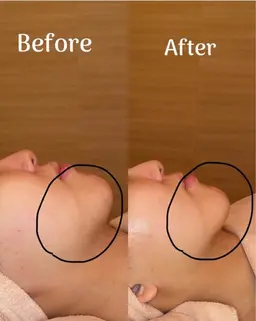 【顔浮腫み・凝り・疲れに】小顔オイルマッサージ+EMS+美ツヤ肌アンプル導入