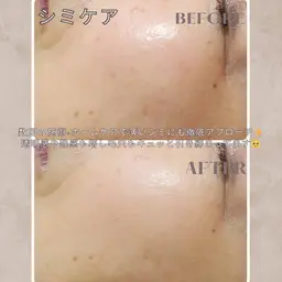 【大好評✨ハーブピーリング３回コース】毛穴ケア×韓国では定番細胞活性化促進光フェイシャル付き✨ダウンタイムなし✖️90分