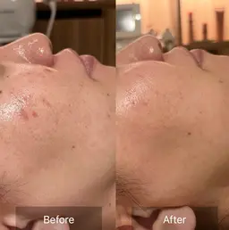 【🔥12/26.27.2829限定🔥ピーリング初めての方におすすめ】ピーリングや毛穴ケアが限定価格で体験🌿