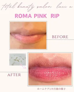 12月中40%OFF更に小顔矯正特典ありローマピンク(唇💋)メラニン除去ケア