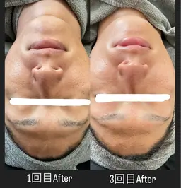 剥けないハーブピーリング🌿＆生パックハイドロジェリーマスク🩷肌質改善！