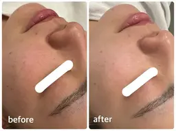 【ご新規様特別価格】肌質改善/リラックス🫧フェイシャルマッサージトリートメント