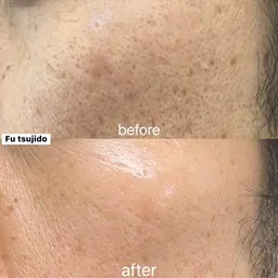 【男性限定】韓国式ハーブピーリング◆¥19880→