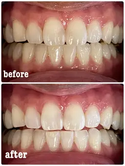 先着5名限定！自然に白くなるセルフホワイトニング✨ 今だけ《照射1回サービス》