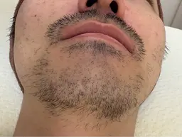 【メンズ・顔脱毛】 顔全体・アゴ下ヒゲも🆗 ¥14.800→¥6.980