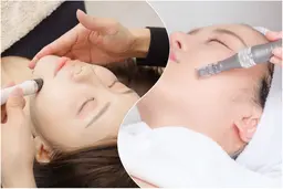 【黒ずみ×毛穴引き締め】毛穴洗浄ハイドラフェイシャル×エステ版ダーマペン（DTほぼ無し）　毛穴縮小/黒ずみ