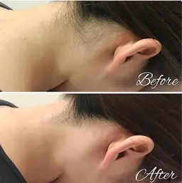 うなじ脱毛+デザインシェービング付¥2500《ポニーテールや前撮り◎》産毛対応✨