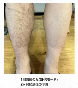 ≪第一印象がかわる！≫メンズ全身脱毛+ヒゲ脱毛🌸【完全都度払い】