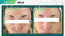 【人気No1★医師推奨/本格肌改善】ハーブピーリング➕韓国で大人気のコラーゲン入りモデリングパック付き