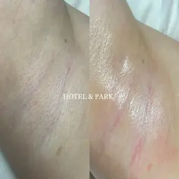 【両脇ワックス脱毛】黒ずみ除去にも◎