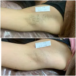 【✨人気No.1✨】両わき脱毛3回🌸まずは定番のわきから💪🏻痛みはないのに目で見てわかるほど効果ばっちり✨