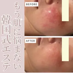 🔥本気で肌改善したい方向け【ニキビ跡・毛穴開き】ララピール✖️最強導入機