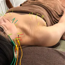 【当日予約限定】小顔美容鍼&美乳鍼コース（小顔/リフトアップ/バストアップ）