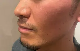 男性髭脱毛🍃保湿パック➕ヘッドマッサージ付き