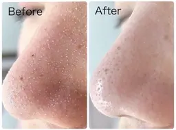 毛穴悩みに◎【3D毛穴洗浄＋高保湿パック付】