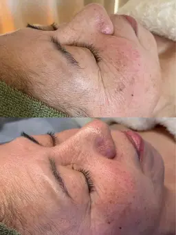 【たるみ、フェイスライン集中】塗るボトックス級REVIハーブピーリング