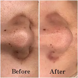 【🌟毛穴汚れザラつき僕滅メニュー🌟】全顔毛穴洗浄＋ハイドロジェリーマスク