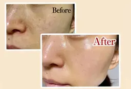 ニキビ•ニキビ跡•水光肌！【肌質改善ハーブピーリング＋高保湿うるつやパック✨】¥6980