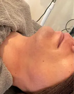 12月限定🎄メンズ ヒゲ口周り脱毛 【痛みを最小限に抑えた光脱毛💡】ヒゲを無くして印象🆙⇒清潔感・明るい・若見え