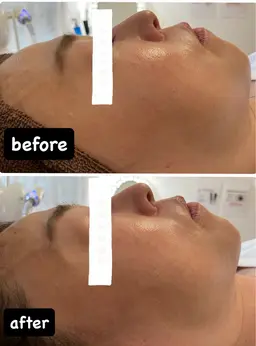 たるみ、二重アゴ撲滅キャンペーン