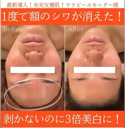 【本日空きあり】大人気🫧艶肌ララピール