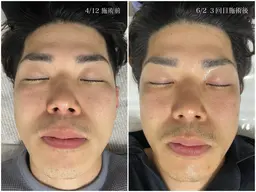 【肌質改善No.1】プラズマスキン（ニキビ/シミ/毛穴）