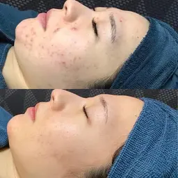 【ニキビ・ニキビ跡・肌荒れ】肌再生ピーリング🧊