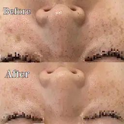 【小鼻の頑固な黒ずみ・毛穴詰まりに！】小鼻毛穴洗浄🫧症例モデル募集★CHRISTINAスキンケア仕上げ付き♡