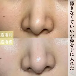 【お試し毛穴洗浄】鼻ハイドラ