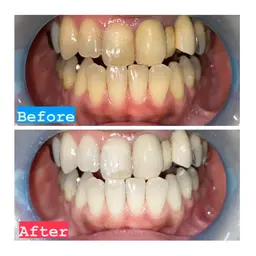 手軽に白い歯、叶えませんか？💎セルフホワイトニング プレミアムコース