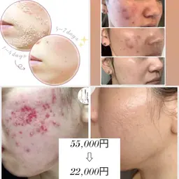 人気No.1🧡ハーブ界1の肌結果FCR/リベル剥離ありハーブピーリング🌿クレーター、ニキビ跡はこちらのコースを！