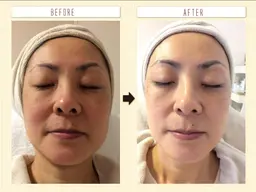 【顔脱毛(光フェイシャル)】(30分)