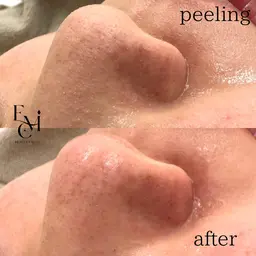 予約殺到★【詰まり・ざらつき撃退】毛穴洗浄（鼻のみ）￥4,400→￥3,300