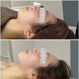 【あっという間に小顔へ💆🏻‍♀️】 お顔の筋膜リリースと骨格調整でシュッとしたフェイスラインGET✨施術時間60分