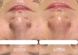 【毛穴ケア】×【潤肌】光と洗浄で悩みの種撃退❗️セルフケアでは届かない肌の奥から悩み改善✨✨赤み/くすみ/毛穴