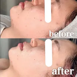 【2名限定】剥離なし国産ハーブピーリング＋幹細胞ペプチド・ペップビューエレポ導入でしっかり毛穴レス✨️