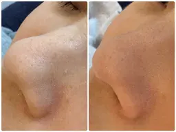 毛穴洗浄フェイシャル