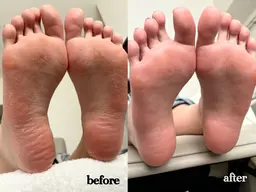 【極上👣しっとりツルすべ足裏角質ケア】※足湯＆パラフィンパック付き