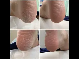 フットキュアコース