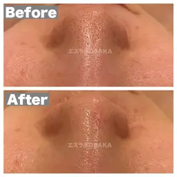 【高濃度水素毛穴洗浄】✖︎【ピーリング洗浄】