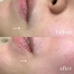 フェイシャルワックス脱毛