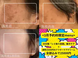 3/22完全閉店感謝メニュー　本格シミケア30分ケア放題＋ホームケアセット"15000円相当付き。25,000円