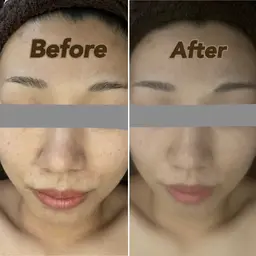 【お写真必須クーポン】フェイシャルのBefore After撮影にご協力いただける方へクーポン