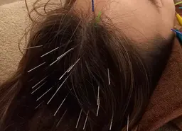 【頭皮のコリ・自律神経乱れ(不眠)・髪のハリやコシ・育毛には頭皮鍼🪡💆🏻‍♀️】ヘッドマッサージ付