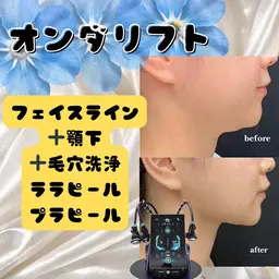 オンダリフト25分｜フェイスライン顎下80kj~140kj＋鼻の毛穴洗浄＋ララピールorプラピール