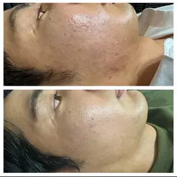 ミニモ限定セール【人気No.2 美肌小顔に💆♀️】小顔矯正×最新ハーブピーリング